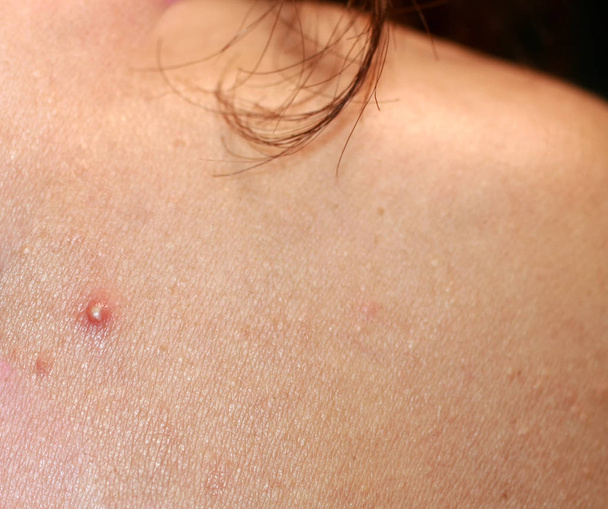 Inflamed skin on the face. Acne. Pimples on the skin. Scars and peeling. - Photo, Image