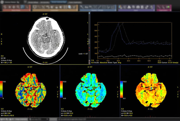 Beynin perfüzyon tomografi görüntüsü 3D görüntüleme görüntüsü ekranda analiz ediliyor. - Fotoğraf, Görsel