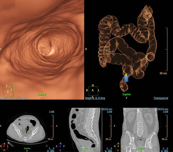 CT colonography compare 2D Axial, sagittal, plan coronal et image de rendu 3D pour le dépistage du cancer colorectal. Check up Dépistage du cancer du côlon
. - Photo, image