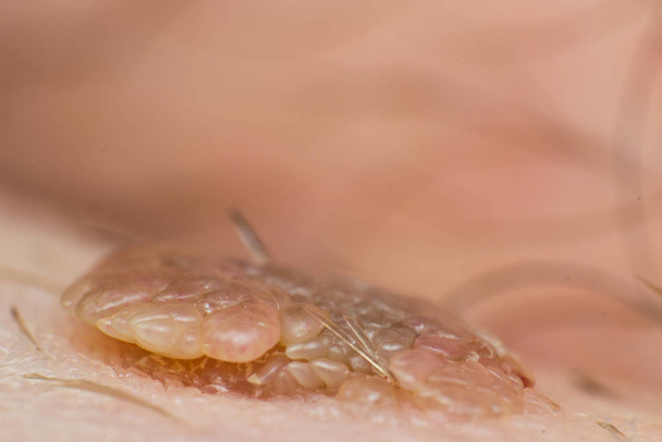 皮膚の傷、乳頭腫ウイルス感染症のマクロ写真 - 写真・画像