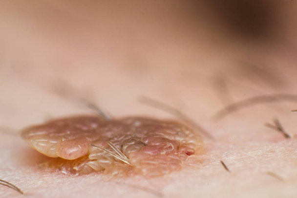 Macro foto di una verruca della pelle, infezione da virus papilloma
 - Foto, immagini