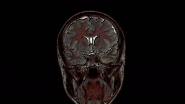 Resonancia magnética multicolor masiva del cerebro y la cabeza para detectar tumores. Herramienta médica de diagnóstico
 - Imágenes, Vídeo