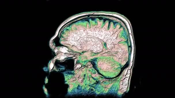Massenhaft mehrfarbige MRI-Scans von Gehirn und Kopf, um Tumore zu erkennen. Diagnostisches medizinisches Werkzeug - Filmmaterial, Video