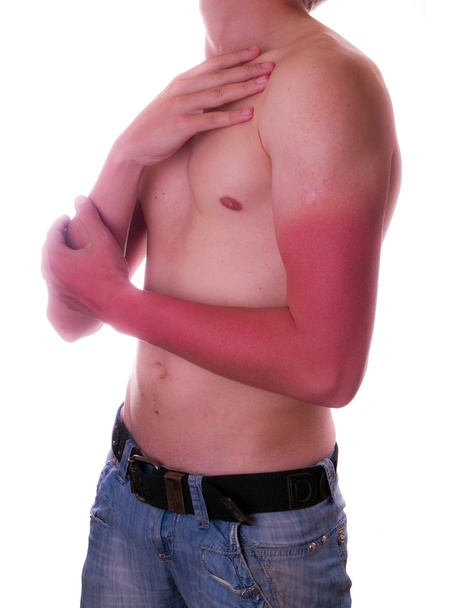 Man Sunburned hands - Foto, afbeelding