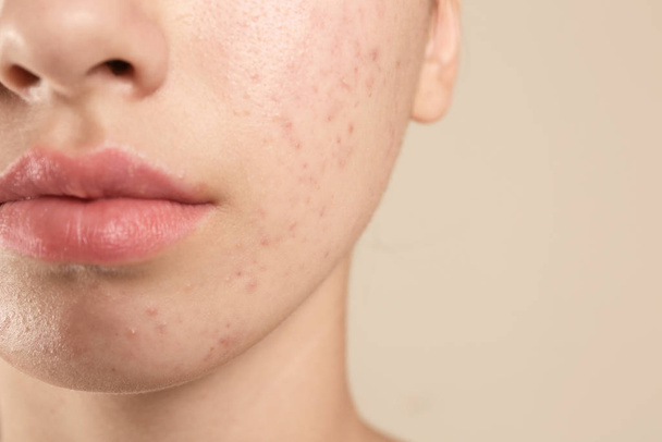 Teenage girl with acne problem on beige background, closeup - 写真・画像