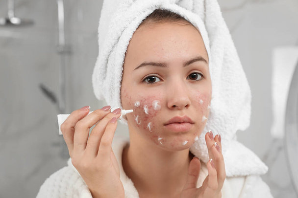 Teen girl with acne problem applying cream in bathroom - Фото, зображення