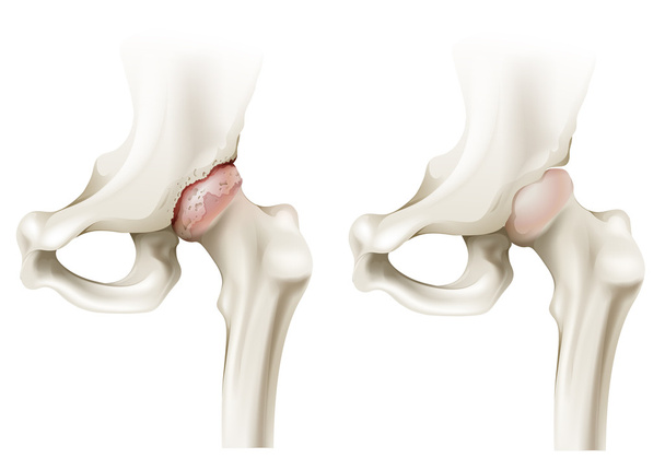 artrite da anca
 - Vetor, Imagem