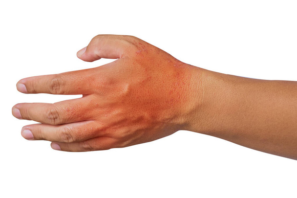 Swędzenie chorób skóry u mężczyzn stosujących drapanie ręczne. Czerwony a - Zdjęcie, obraz