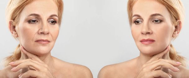 Comparison portrait of middle-aged woman before and after filler injection on light background - Photo, image