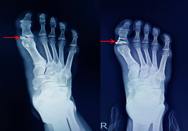 X-ray ayak kırığı proksimal phalang ve ameliyat mini plakayı düzeltir.  - Fotoğraf, Görsel