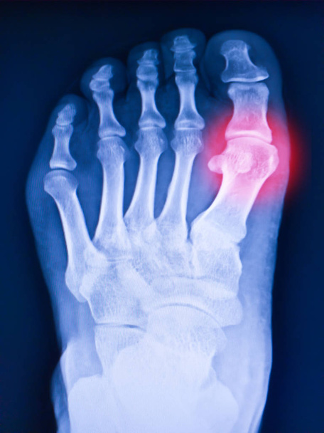 Pie de rayos X y artritis en la articulación metatarsofalángica (dedo gordo del pie a
 - Foto, imagen