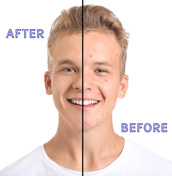 Teenage boy after and before acne treatment on white background - Photo, Image