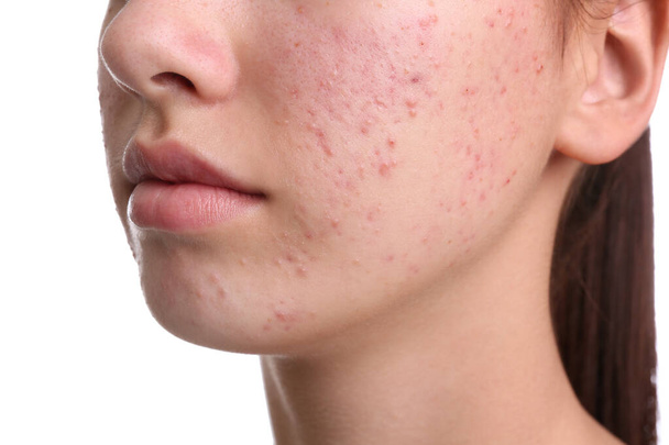 Teenage girl with acne problem on white background, closeup - Фото, зображення