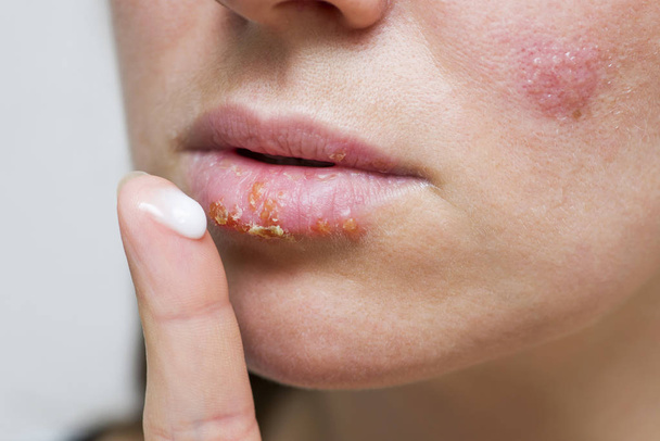 Part of a young woman's face with a virus herpes on lips, treatment with ointment. Young woman with cold sore applying cream onto lips - Φωτογραφία, εικόνα