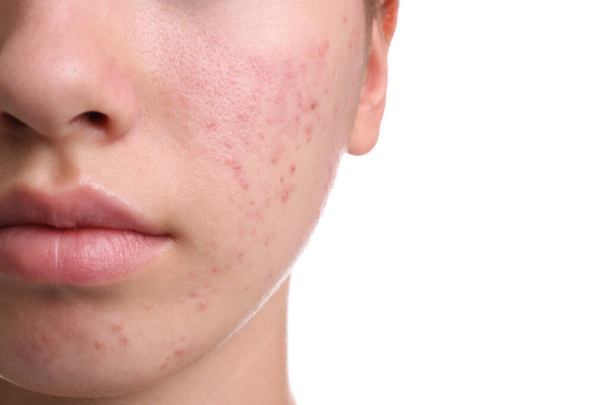 Teenage girl with acne problem on white background, closeup - Φωτογραφία, εικόνα