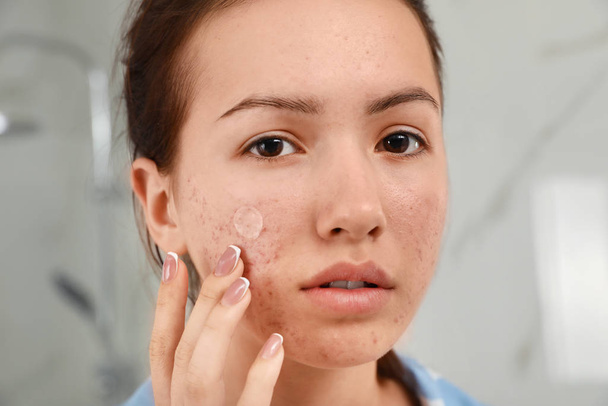 Teen girl applying acne healing patch indoors, closeup - Zdjęcie, obraz