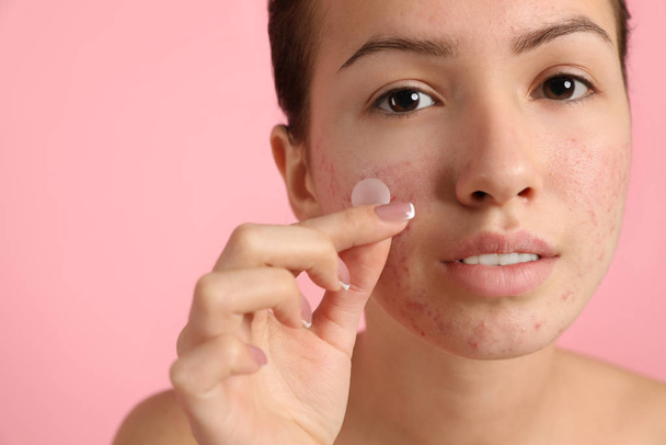 Teen girl applying acne healing patch on light pink background - Foto, Imagem