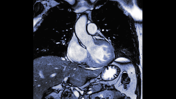 Resonancia magnética cardiaca o cardíaca por resonancia magnética del corazón en la TSVI que muestra el tracto de salida del ventrículo izquierdo para detectar enfermedades cardiacas
. - Metraje, vídeo