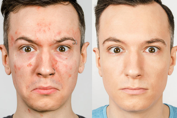 dos chicos antes-después: chico izquierdo con acné, manchas rojas, piel problemática, chico derecho con la piel sana. Concepto de tratamiento del acné
 - Foto, Imagen