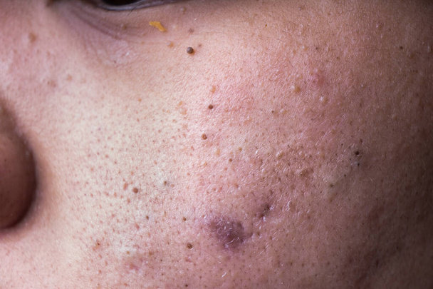 Потворні прищі чорні голови на щоці обличчя підлітка
 - Фото, зображення