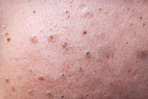 Ugly pimples blackheads on face of teenager - Foto, imagen