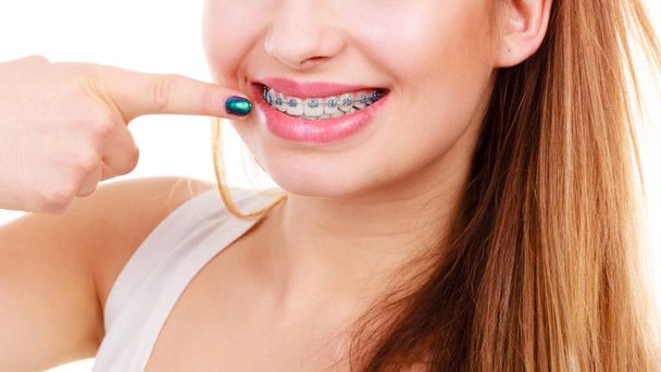 Nainen näyttää hampaansa hammasraudoilla
 - Valokuva, kuva