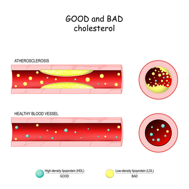 good (HDL) and bad (LDL) cholesterol. Healthy blood vessel and A - Vector, Image
