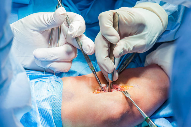 Grupo de cirurgiões que realizam uma cirurgia do cotovelo
 - Foto, Imagem