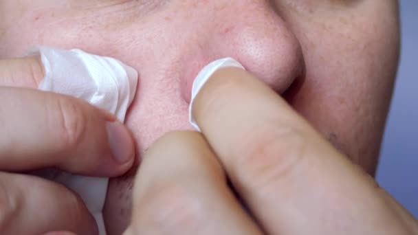 Hombre apretando el acné en la cara
 - Metraje, vídeo