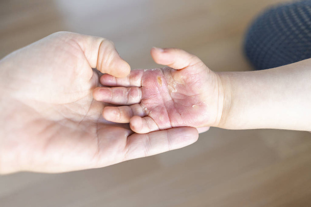 Oparzona ręka małego dziecka - Zdjęcie, obraz