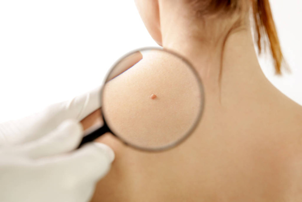 Dermatologe überprüft Maulwurf durch Lupe - Foto, Bild