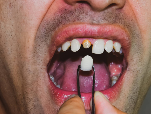 patient without a tooth is trying on a denture - 写真・画像