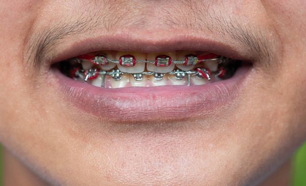 Закрыть брекеты на зубах азиатского мальчика
. - Фото, изображение
