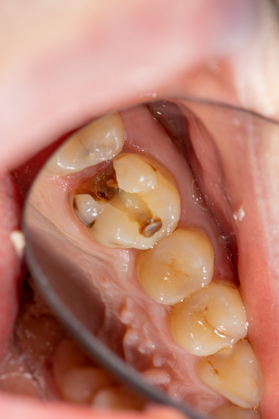 Tratamento das raízes do dente. Selagem e limpeza de um cari
 - Foto, Imagem