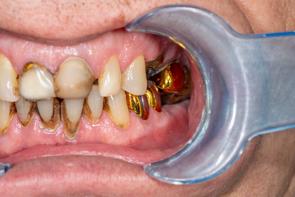Zubní koruna kovová keramika detailní záběr v ústech pacienta v t - Fotografie, Obrázek