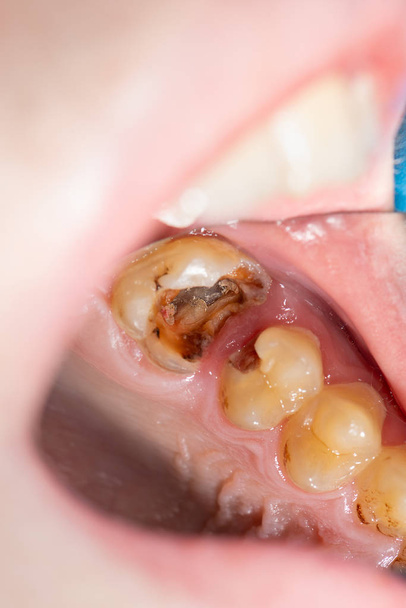 Карієс і захворювання зубів. Заповнення зубною композитною фотопанеллю
 - Фото, зображення
