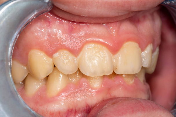 Placa do paciente, pedra. Tratamento odontológico da traqueia dentária
 - Foto, Imagem