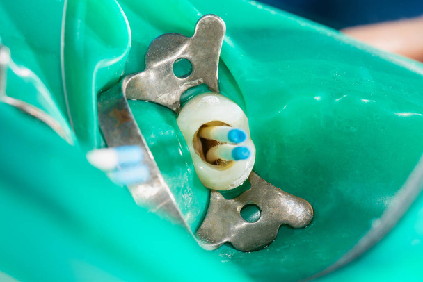 photo endodontic treatment of dental canals in the lower molar p - Photo, Image