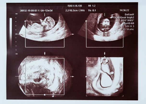 Ultrasound scan of a child. Collage, different angles. - Photo, Image