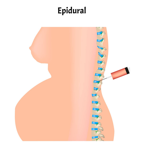 Anestesia epidural durante el parto. Anestesia epidural de mujeres embarazadas. Ilustración vectorial
. - Vector, imagen