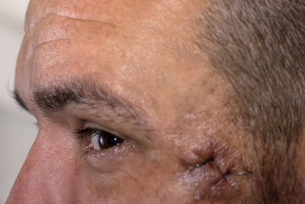 Medische hechtingen op het gezicht na een operatie aan het slaapbeen. Hechtwond bij de tempel. Naaide huid op het gezicht van een jonge man na de operatie - Foto, afbeelding