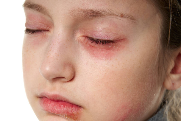 Allergiás reakció, bőrkiütés, közeli kép egy lány arcáról. A bőr kivörösödése és gyulladása a szemben és az ajkakban. Immunrendszeri betegség. - Fotó, kép