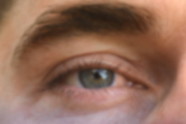 Close-up, duidelijk uitgesproken conjunctivitis en roodheid van het oog. - Foto, afbeelding