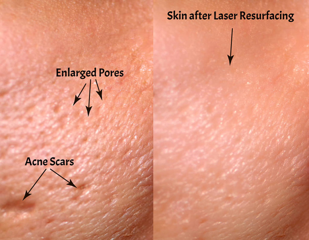 Comparison of skin before and after laser resurfacing. Skin with acne, acne scars, enlarged pores. - Photo, Image