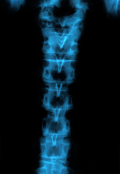 ακτινογραφία των οστών ανθρώπινη σπονδυλική στήλη - Φωτογραφία, εικόνα