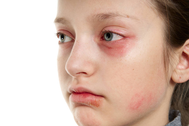 Allergic reaction, skin rash, close view portrait of a girl's face. Redness and inflammation of the skin in the eyes and lips. Immune system disease. - Photo, Image