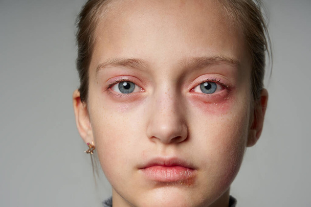 Reacción alérgica, erupción cutánea, retrato de la cara de una niña. Enrojecimiento e inflamación de la piel de los ojos y labios. Enfermedad del sistema inmunitario
. - Foto, Imagen