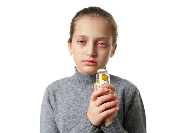 Reacción alérgica, erupción cutánea, retrato de la cara de una niña. Enrojecimiento e inflamación de la piel de los ojos y labios. Enfermedad del sistema inmunológico. Frasco de tabletas y pastillas en la mano del niño
. - Foto, imagen