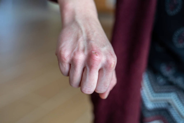 Vilaine brûlure désagréable sur la main de la femme blanche d'âge moyen de la voiture
 - Photo, image