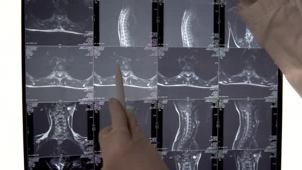 El médico verifica los resultados de la resonancia magnética de la columna vertebral del tórax. El médico examina la imagen de la resonancia magnética y muestra los lugares especiales de la imagen con una pluma.
. - Imágenes, Vídeo